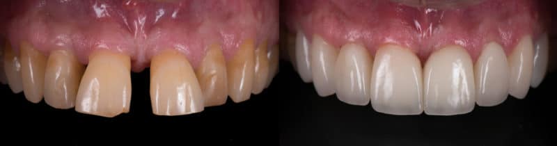 Dental Veneer Santa Rita Dental