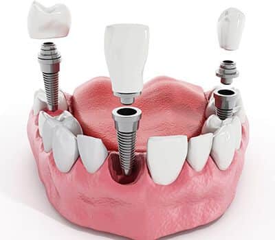 santa-rita-dental-implant santa-rita-dental-implant