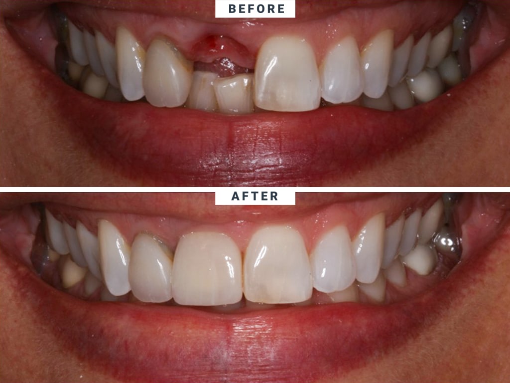 implant before after santa Rita Dental implant-before-after-santa-Rita-Dental