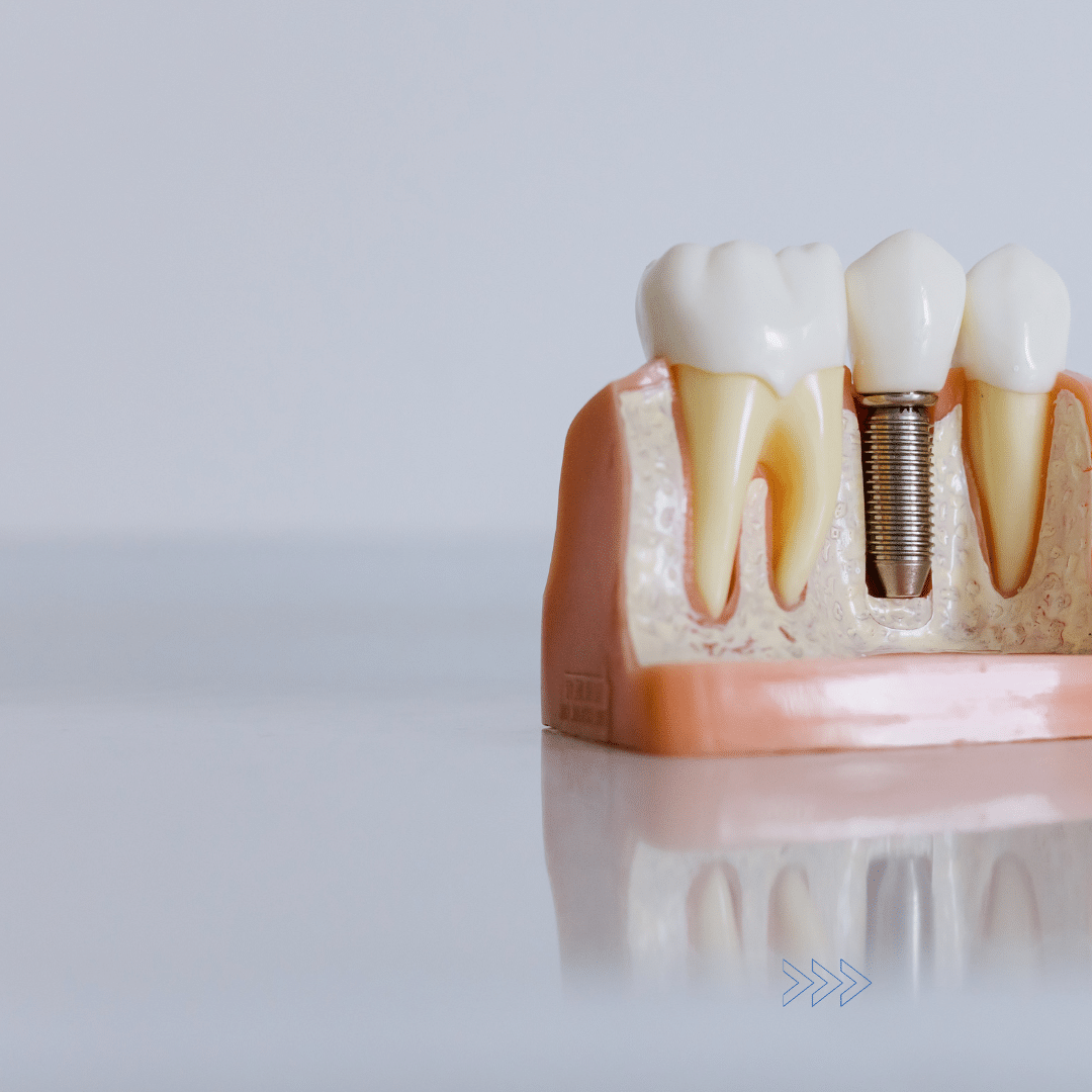 implant vs denture- santa rita dental implant vs denture- santa rita dental