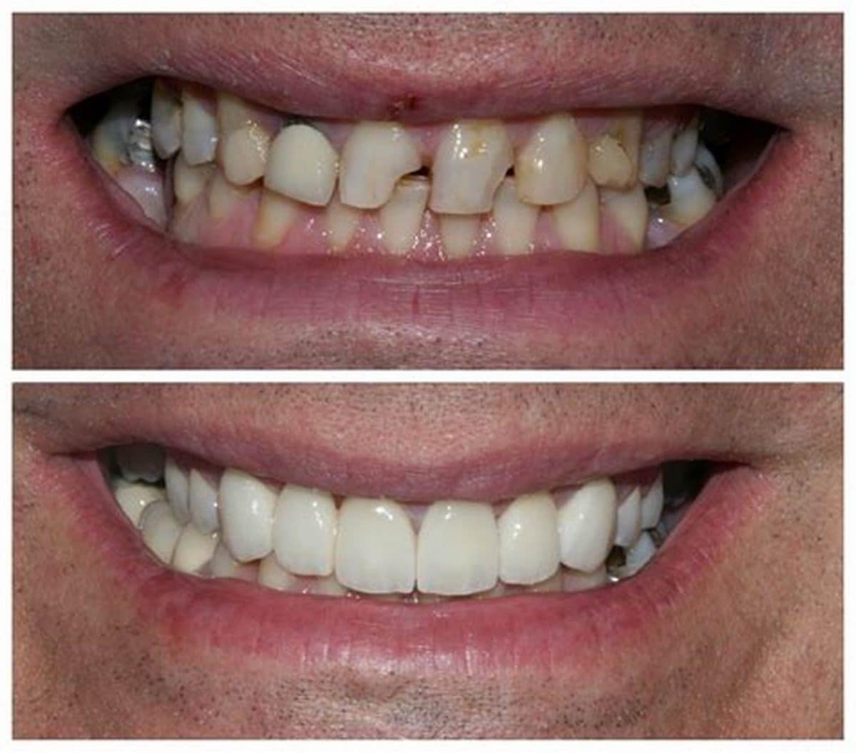 veneer before after Santa Rita Dental veneer-before-after-Santa-Rita-Dental