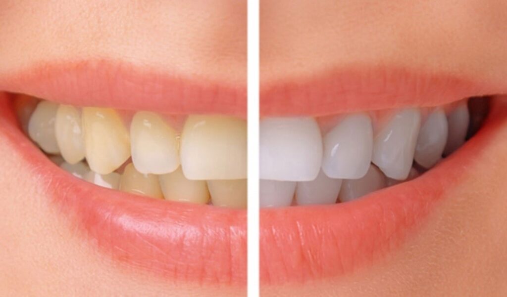 whitening before after Santa Rita Dental whitening-before-after-Santa-Rita-Dental